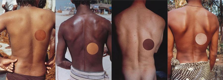 Proposal for Skin Transplant