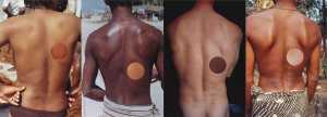 proposal-for-skin-transplant-voorstel-voor-huid-transplantatie